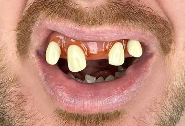 Billy Bob Costume Teeth